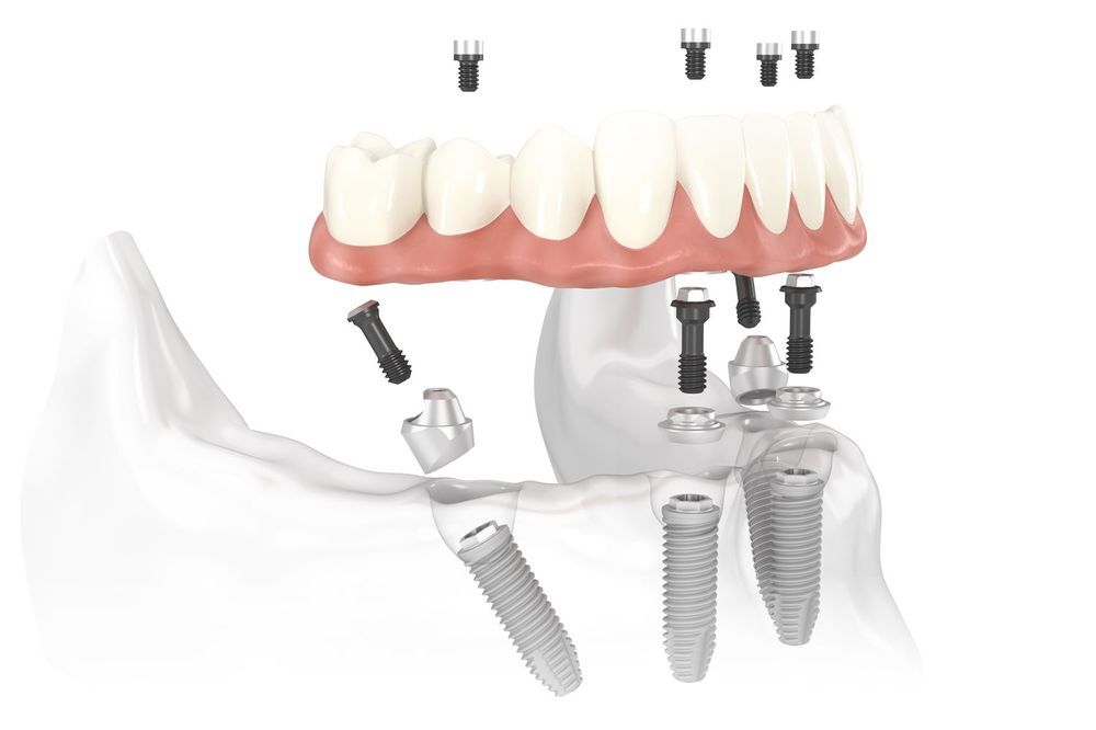 illustration of an all-on-4 denture